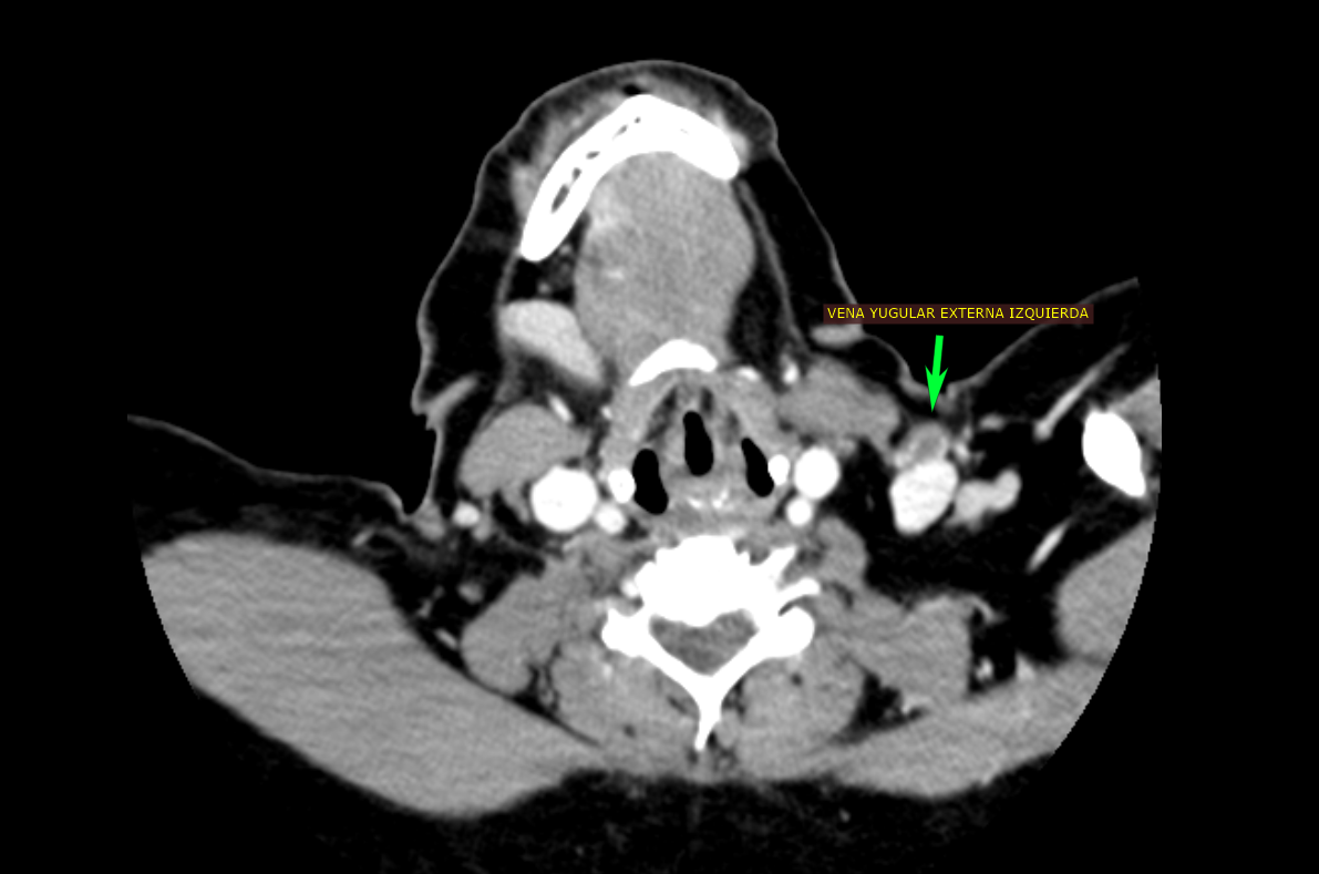 Aneurisma de la vena yugular externa con trombosis parcial: un hallazgo infrecuente diagnosticado mediante angioTC de cuello