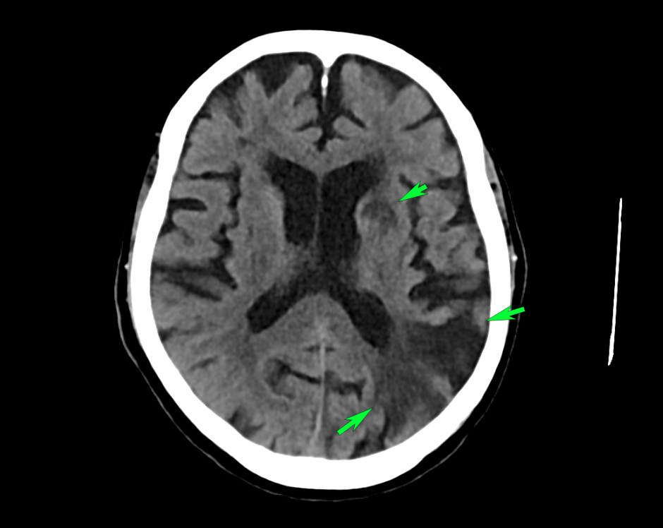 Múltiples infartos cerebrales en diferentes estadios evolutivos: un patrón tomográfico que obliga a buscar la causa subyacente