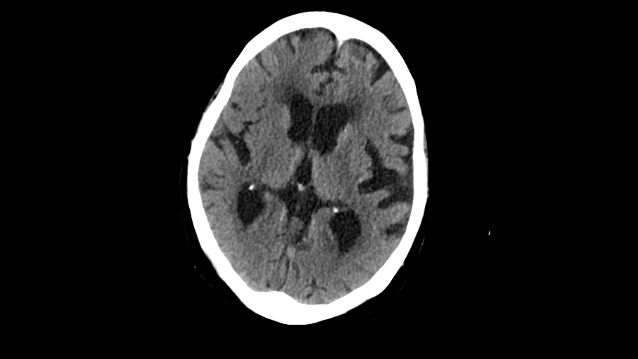 Tomografía cerebral normal en paciente con delirio: la importancia de reconocer la enfermedad de pequeños vasos y evitar falsos diagnósticos de evento vascular cerebral