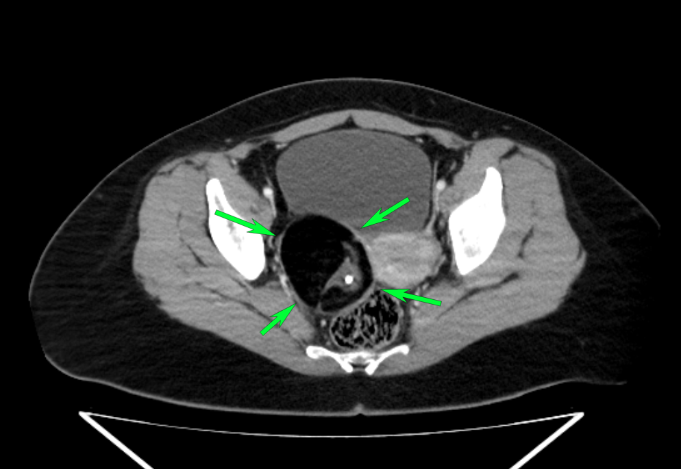 Teratoma quístico maduro de ovario: el clásico signo de la “Pokeball” en tomografía computarizada