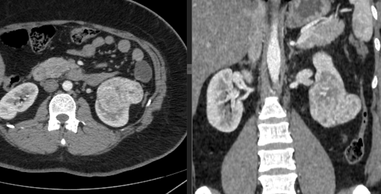 Pancreatitis aguda leve y hallazgo incidental de carcinoma de células renales: la importancia de evaluar sistemáticamente toda la tomografía abdominal