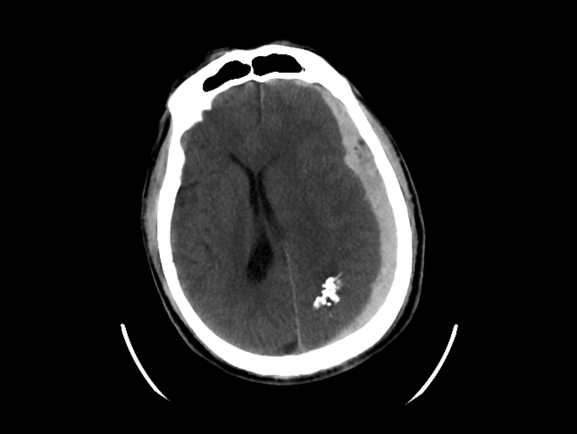 HEMATOMA SUBDURAL